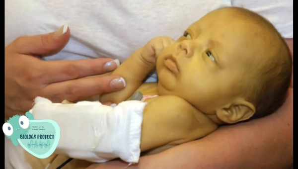 Урсофальк для новорожденногоФизиологическая желтушка у новорожденных – вполне частое и нормальное явление, если она длится несколько дней. Через 2-3 дня у большинства малышей желтизна кожи проходит.
